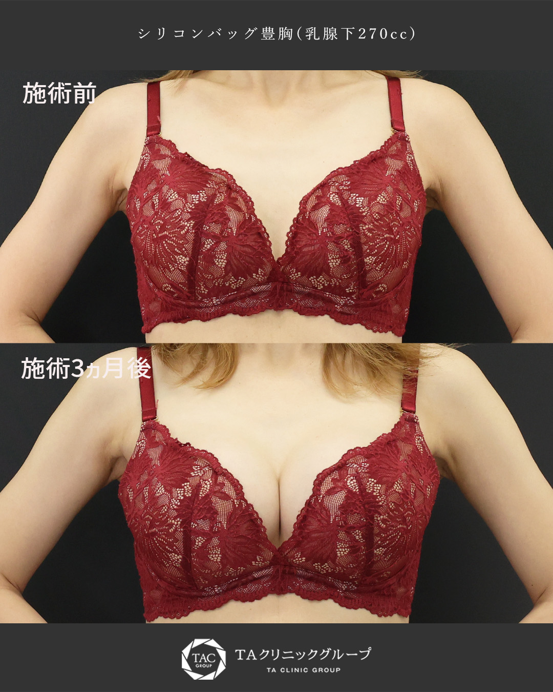 【30代】授乳後のボリュームダウンしたお胸に