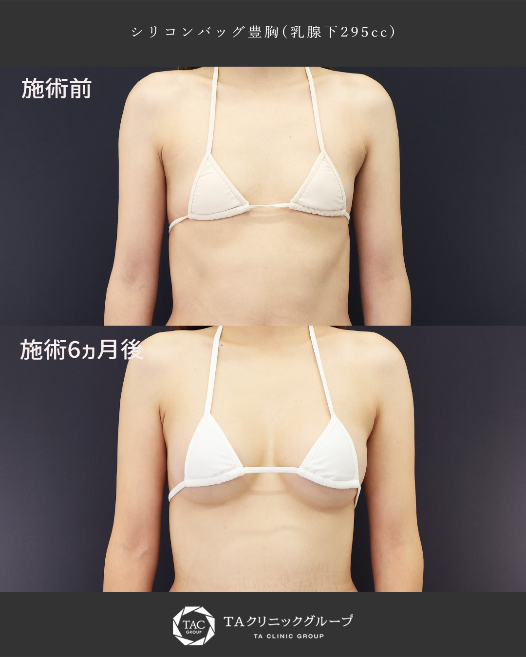 【30代ママ】授乳後のお胸をボリュームアップ│シリコンバッグ豊胸