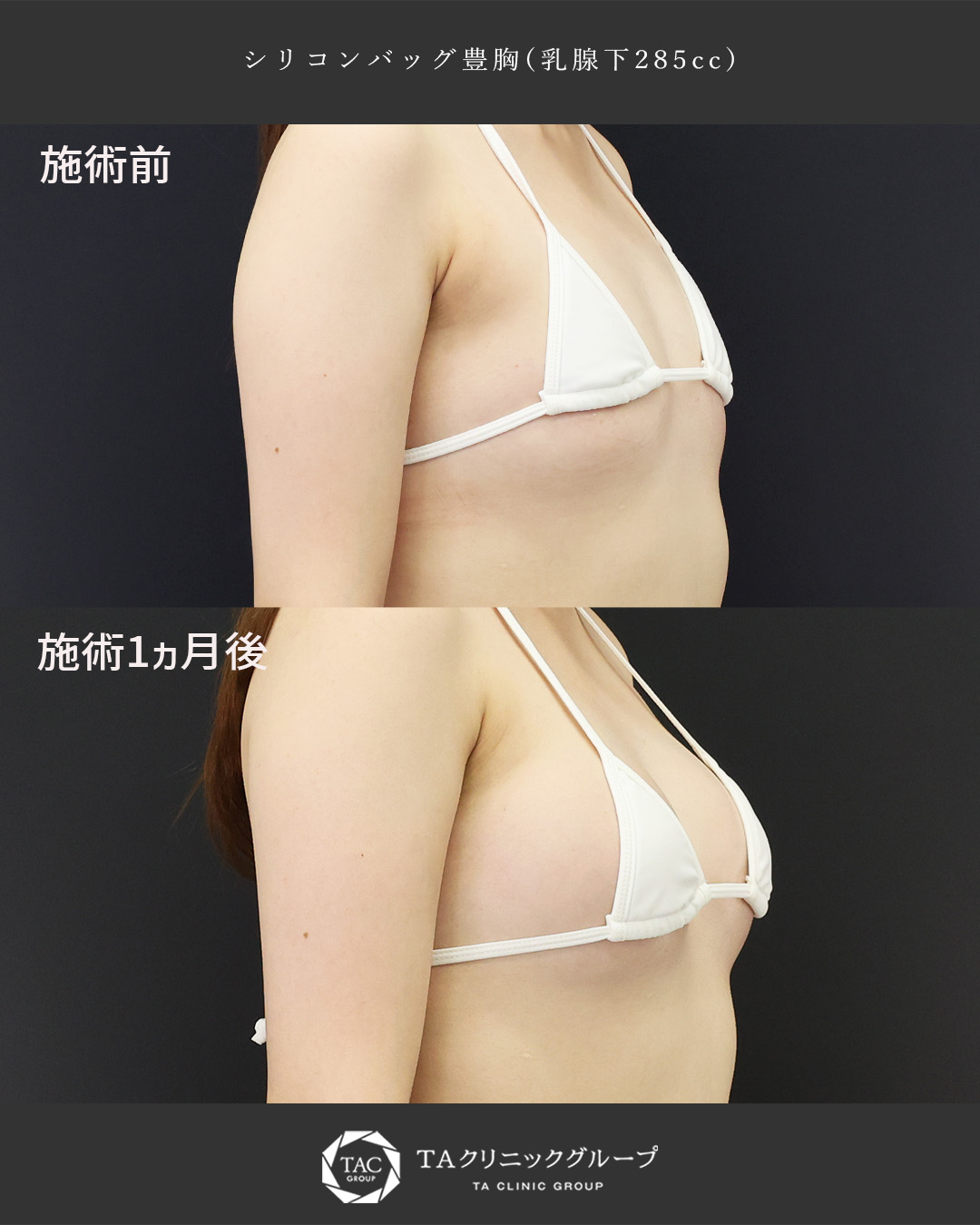 【20代前半│シリコンバッグ豊胸】長年のバストのお悩み解決！