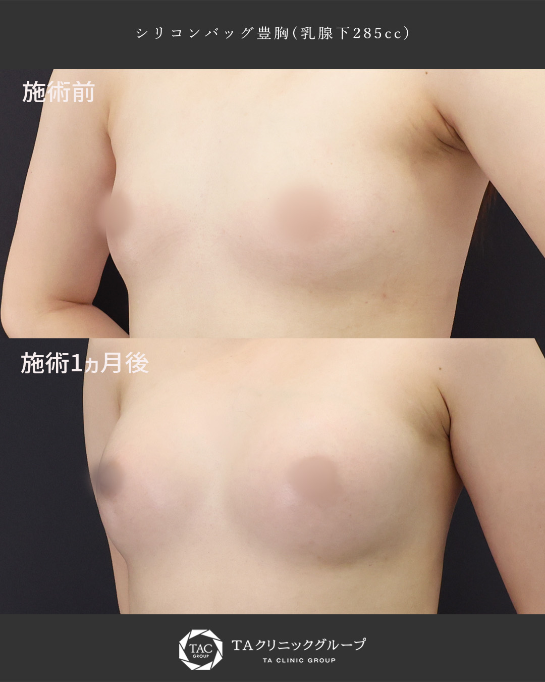 シリコンバッグ豊胸（人工乳腺バッグ）の症例写真 施術前後 