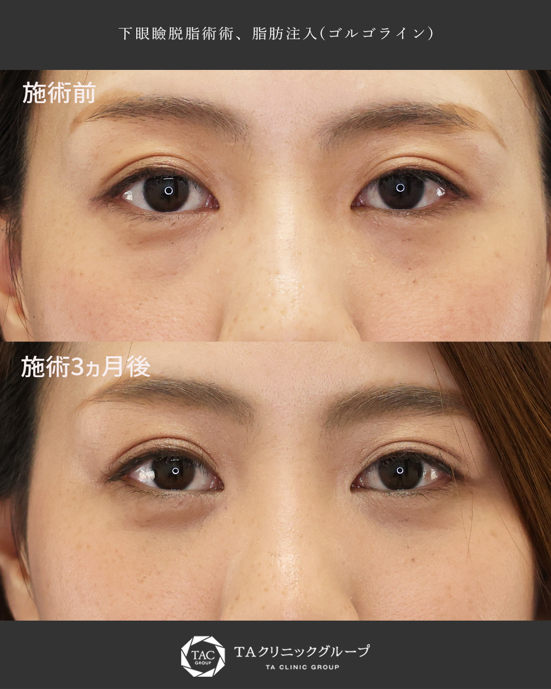 【30代】クマ取り×脂肪注入でお目元を明るく！