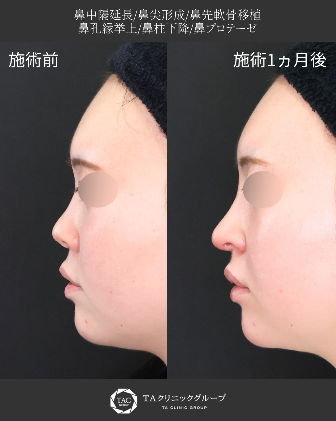 【鼻フル整形】｜鼻先を自然に下に向けて整える◎