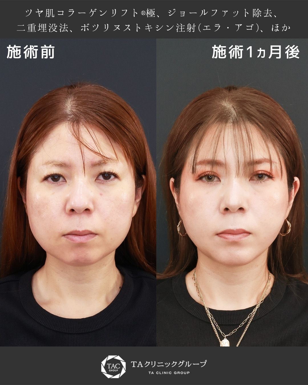 複合施術で－5歳！40代エイジングケア