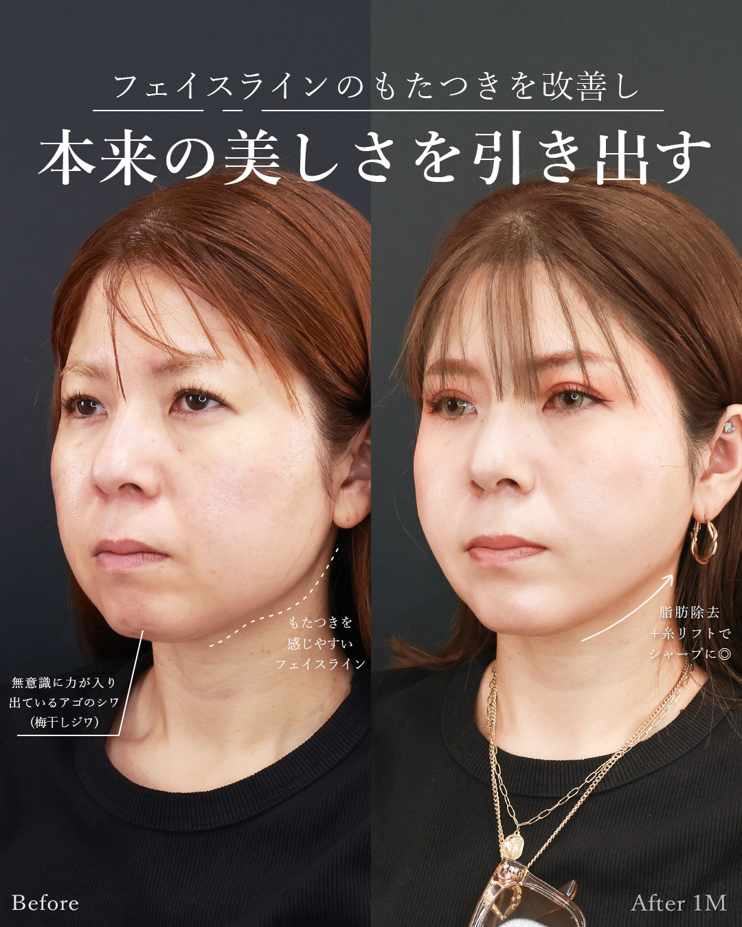 TAC式 ツヤ肌コラーゲンリフト®/ジョールファット除去/二重埋没法の症例写真 施術前後 