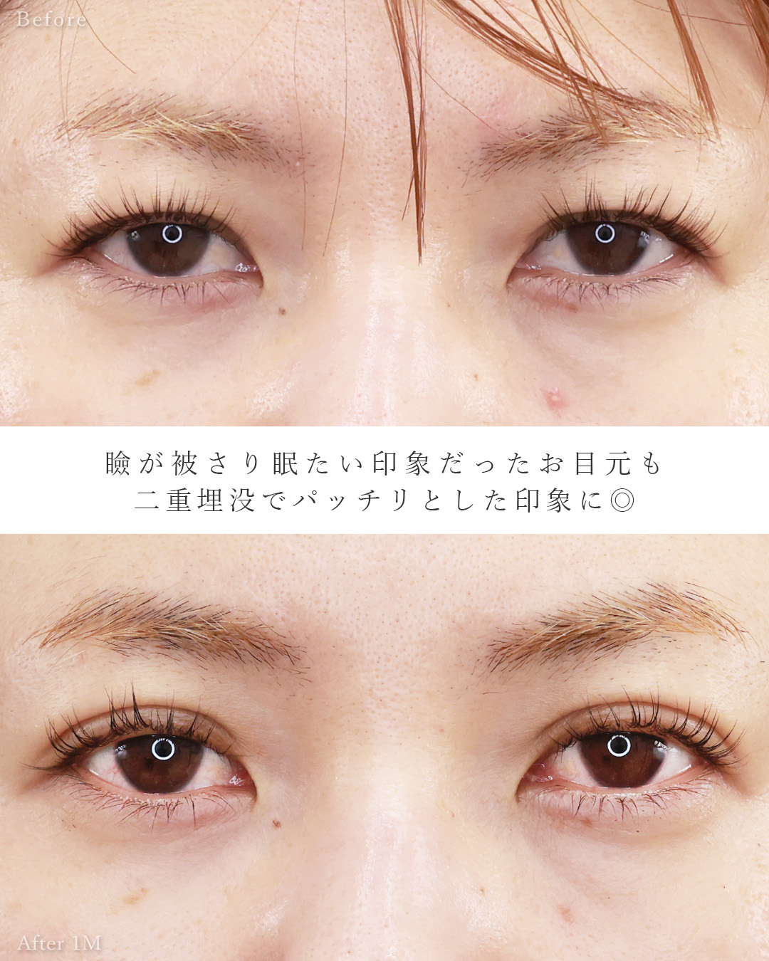 TAC式 ツヤ肌コラーゲンリフト®/ジョールファット除去/二重埋没法の症例写真 施術前後 