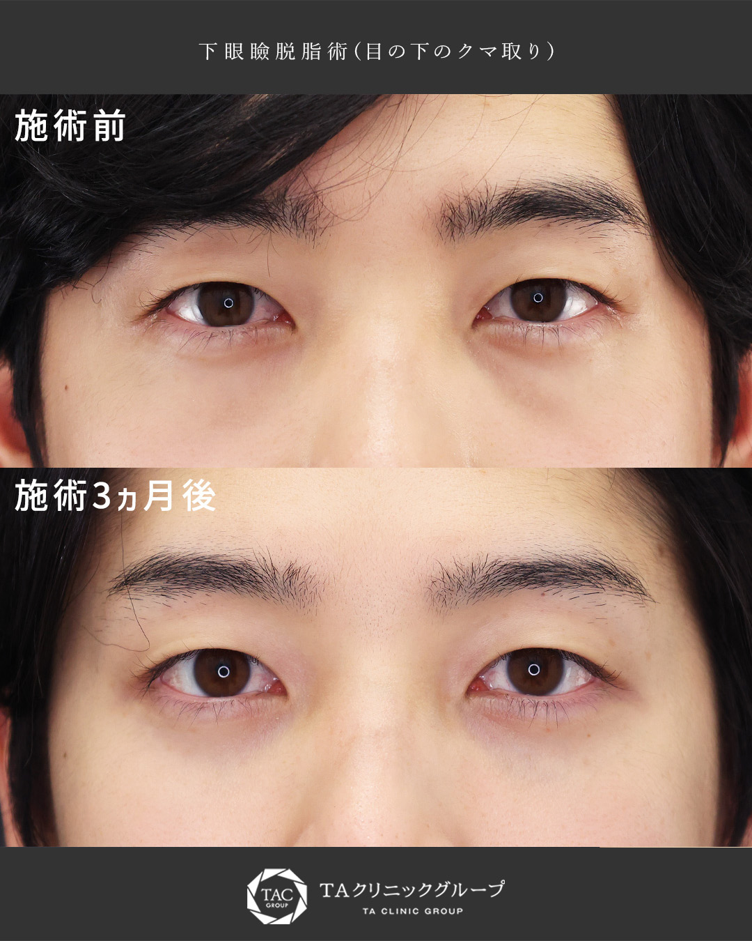 20代メンズ｜クマ取りで疲れている印象を改善!!