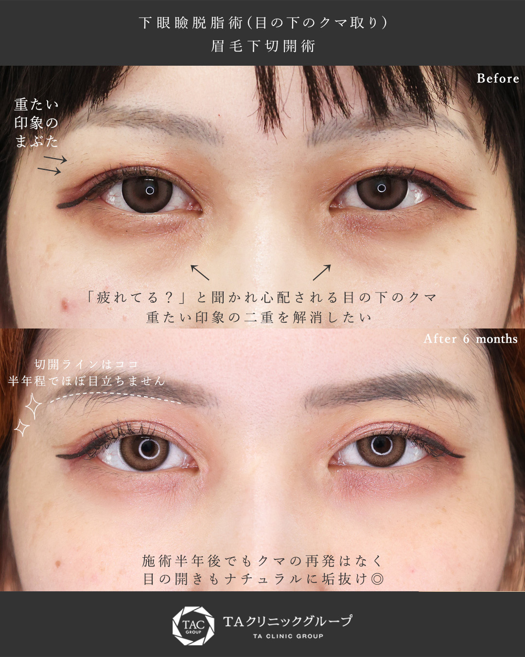 眉毛下切開術/下眼瞼脱脂術（目の下のたるみ取り・目の下の脂肪ふくらみ取り）の症例写真 施術前後 