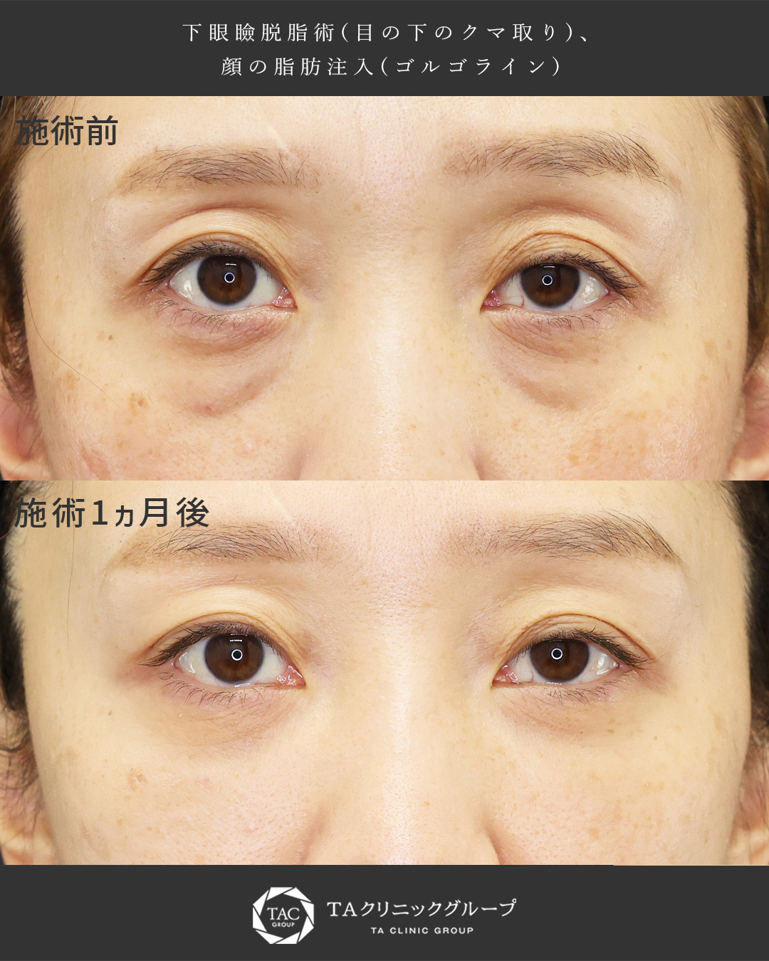 【-10才の印象へ】クマ取りで目の下スッキリ｜若返り