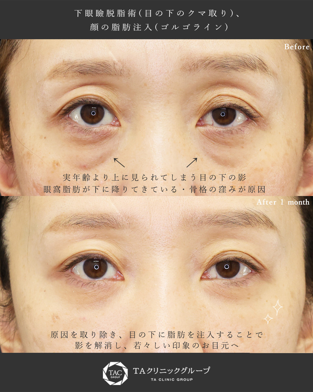 下眼瞼脱脂術（目の下のたるみ取り・目の下の脂肪ふくらみ取り）/顔の脂肪注入(コンデンスリッチフェイス)の症例写真 施術前後 