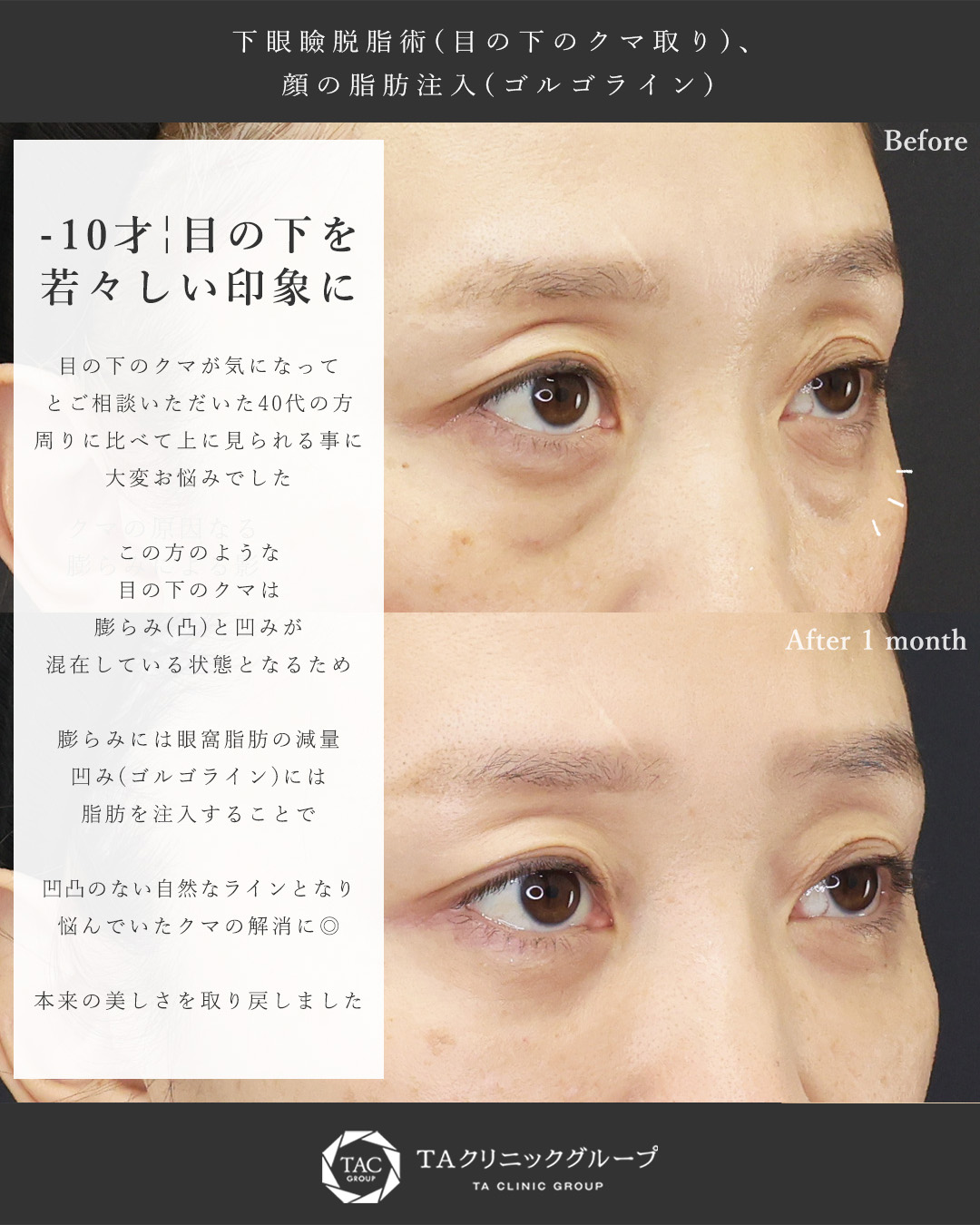 下眼瞼脱脂術（目の下のたるみ取り・目の下の脂肪ふくらみ取り）/顔の脂肪注入(コンデンスリッチフェイス)の症例写真 施術前後 