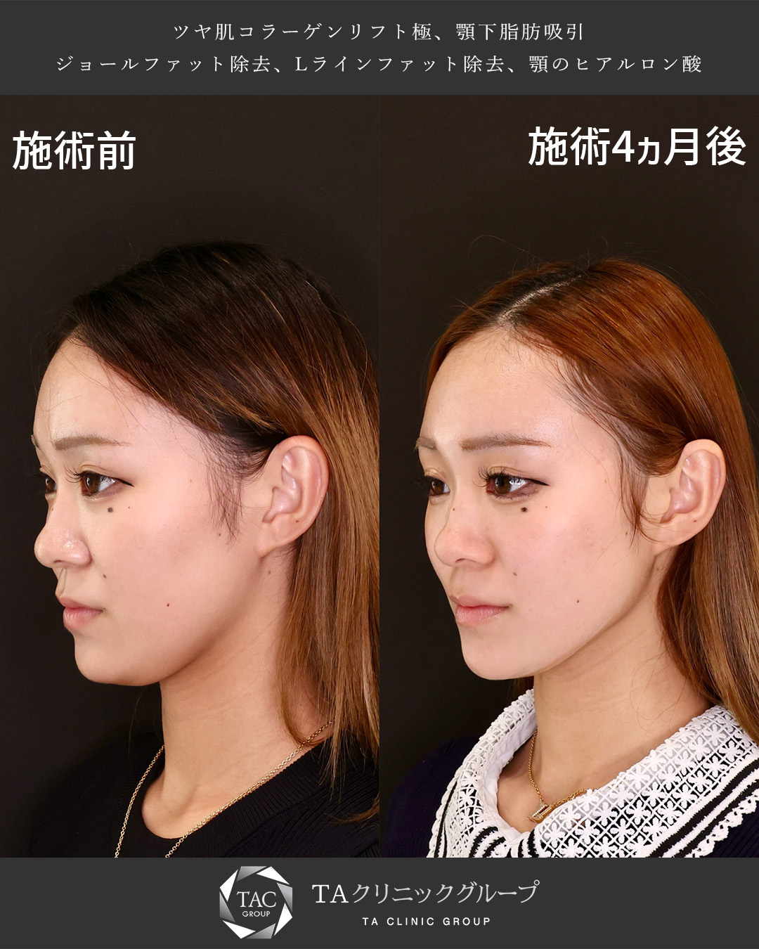 TAC式 ツヤ肌コラーゲンリフト®/Lラインファット除去（エラ下脂肪除去）/顎下の脂肪吸引・顔の脂肪吸引の症例写真 施術前後 