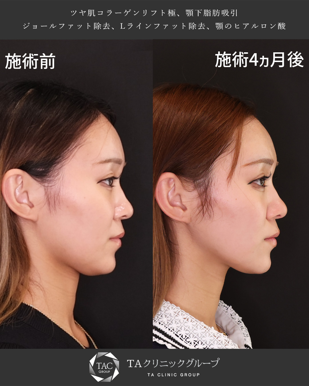 モデル級の美しいフェイスラインに！脂肪吸引で顎下スッキリ♪