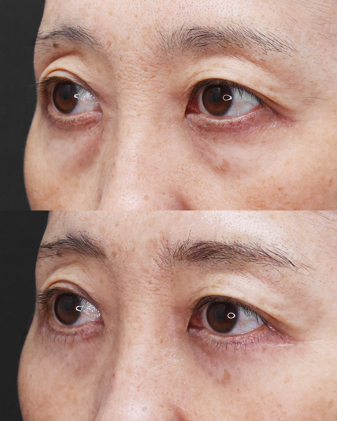 下眼瞼切開術（クマ・たるみとり）の症例写真 施術前後 