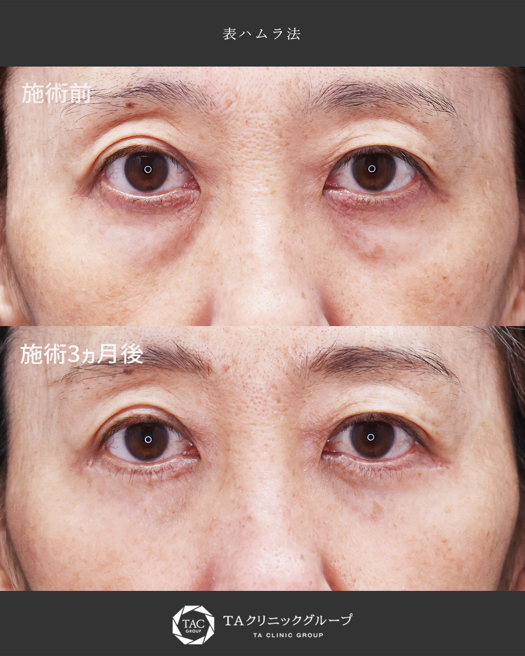 第一印象は目元から【表ハムラ法】でクマ改善