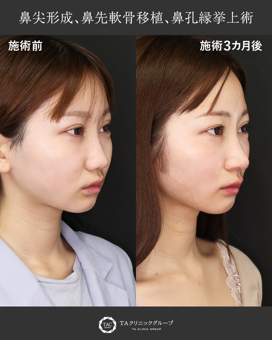 【鼻整形】ナチュラルで立体的な顔立ちに