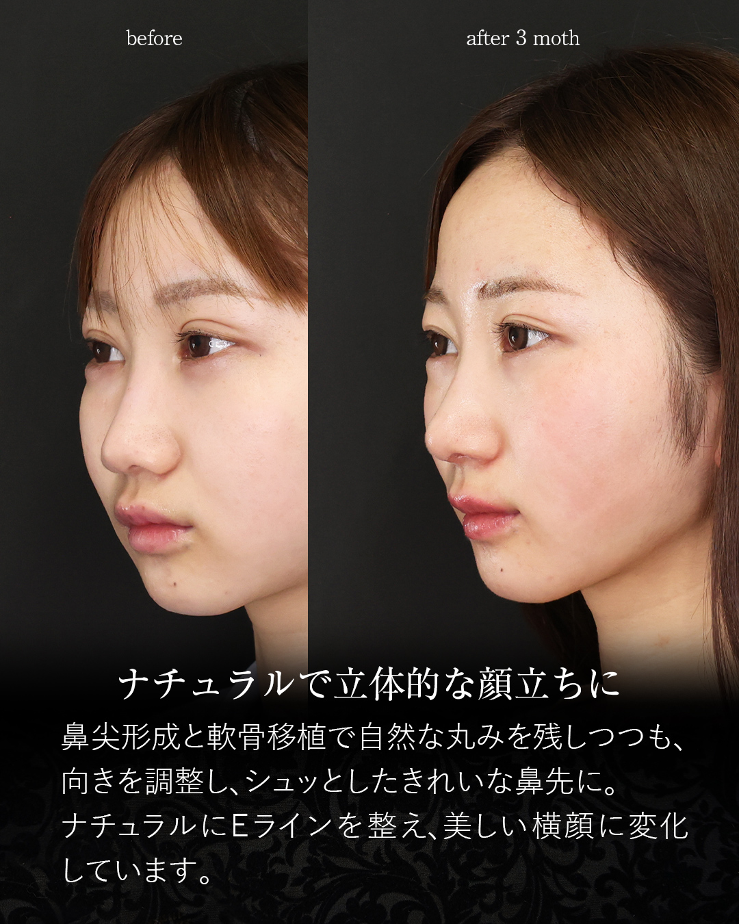 鼻尖形成・鼻尖縮小/鼻先軟骨移植/鼻孔縁挙上術の症例写真 施術前後 3カ月