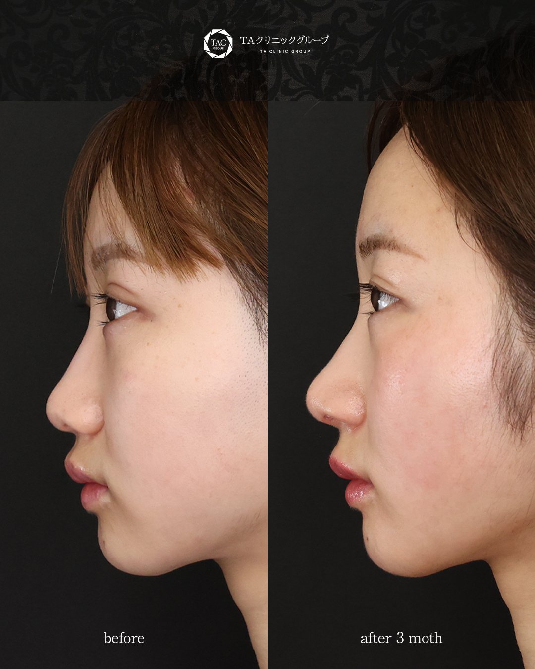 鼻尖形成・鼻尖縮小/鼻先軟骨移植/鼻孔縁挙上術の症例写真 施術前後 3カ月