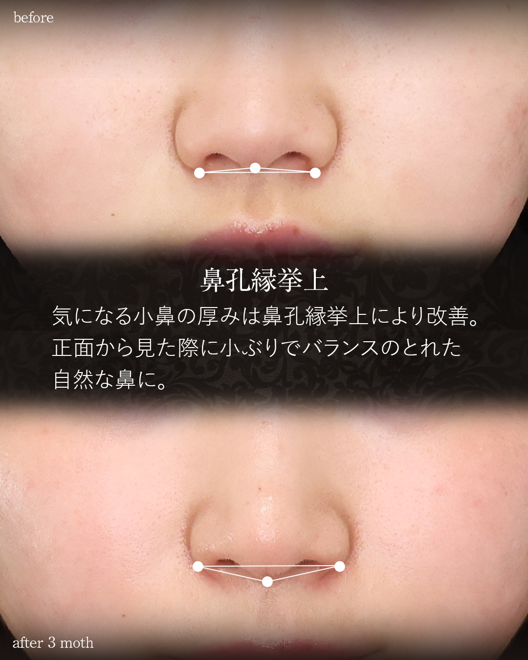 鼻尖形成・鼻尖縮小/鼻先軟骨移植/鼻孔縁挙上術の症例写真 施術前後 3カ月