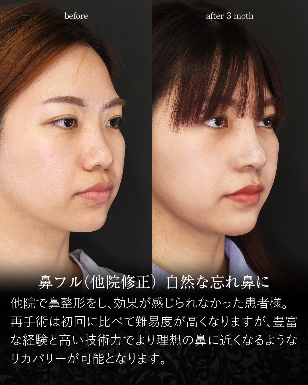 鼻中隔延長術/鼻尖形成・鼻尖縮小/鼻先軟骨移植の症例写真 施術前後 3カ月