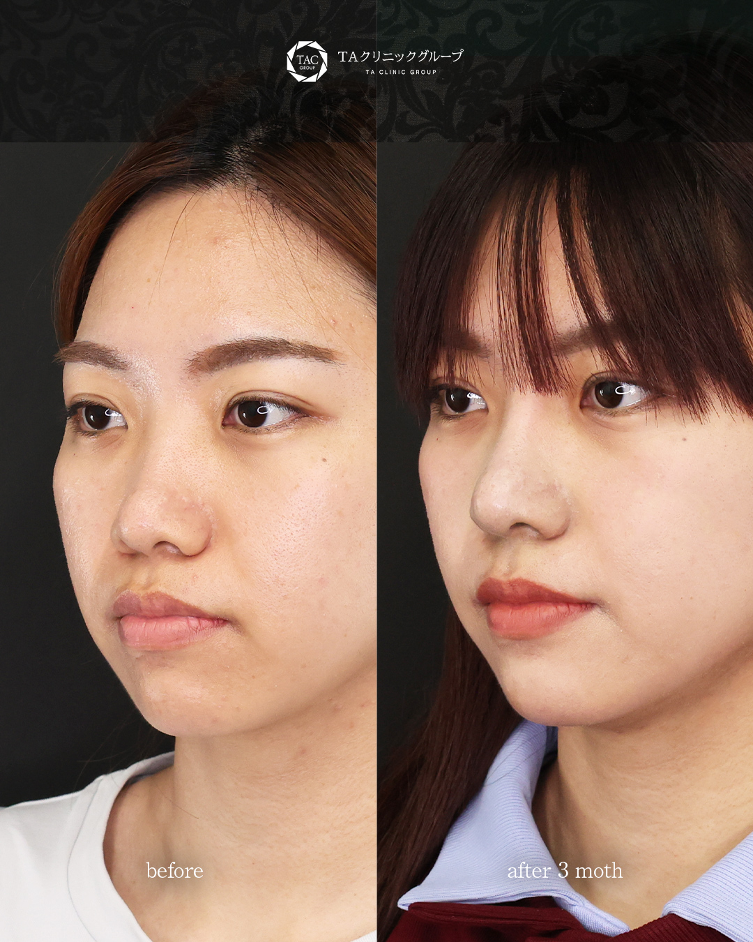 鼻中隔延長術/鼻尖形成・鼻尖縮小/鼻先軟骨移植の症例写真 施術前後 3カ月