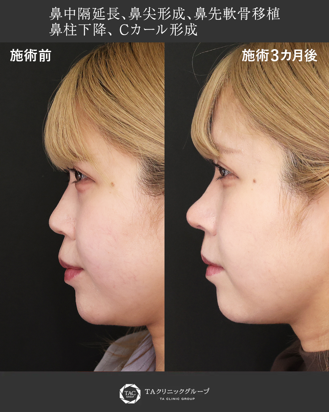 可憐さを引き出す、ナチュラル鼻先形成