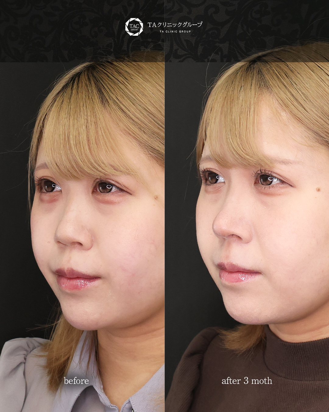 鼻中隔延長術/鼻尖形成・鼻尖縮小/鼻先軟骨移植の症例写真 施術前後  3ヵ 月