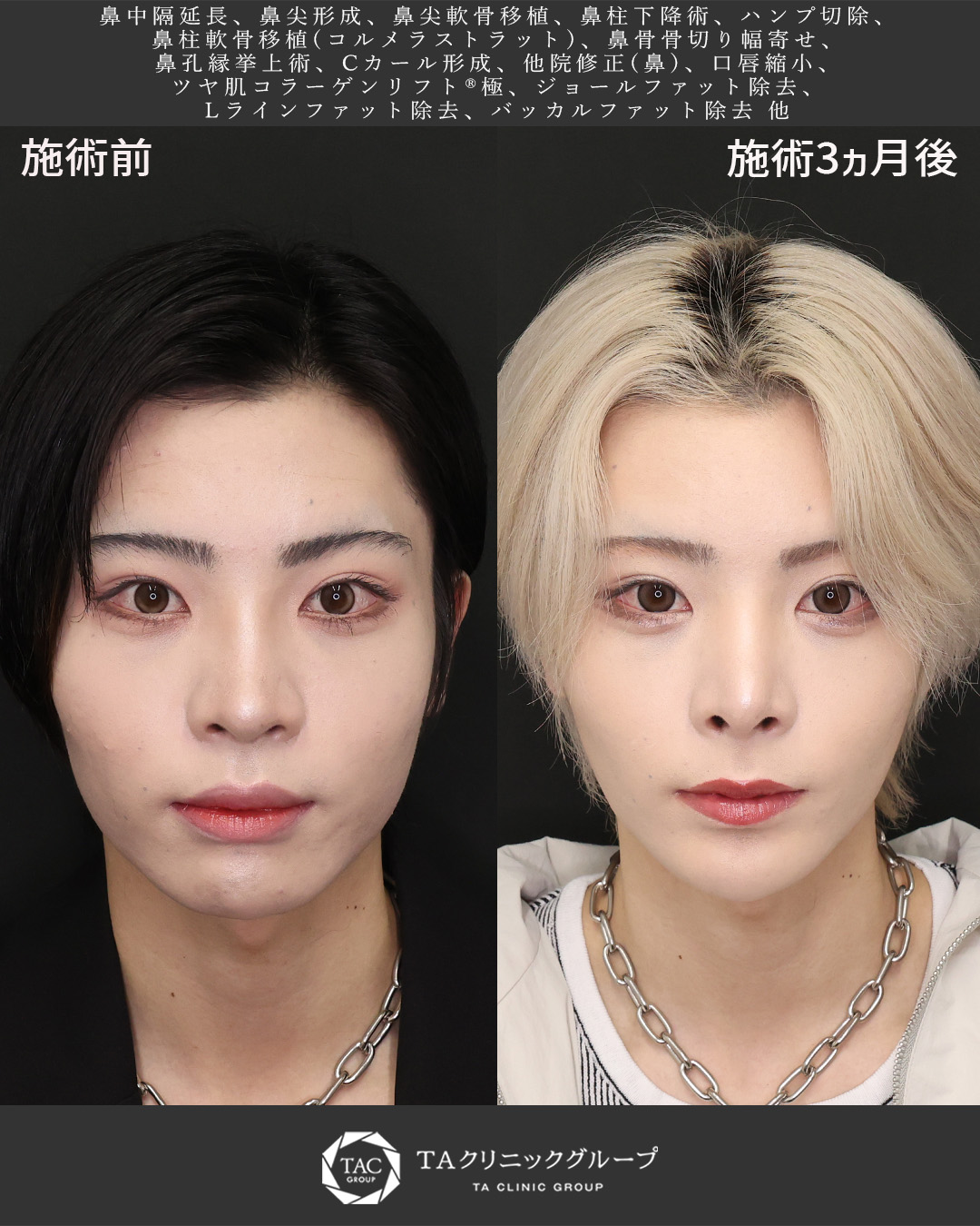 20代男性｜鼻・輪郭・口元まで整える顔全体トータルプロデュース