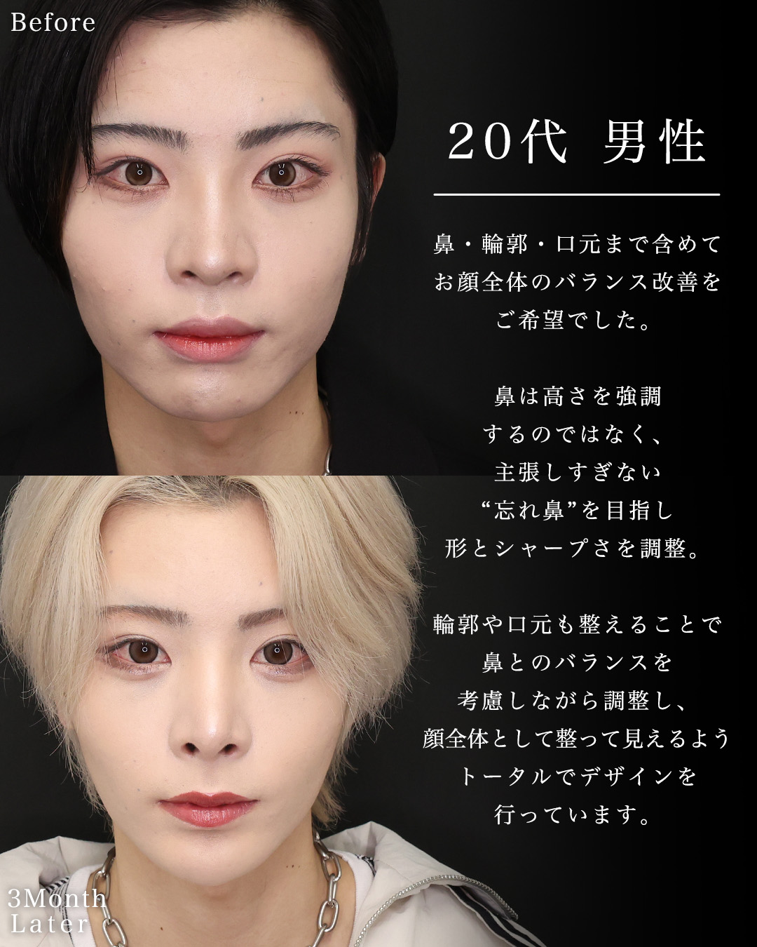 鼻中隔延長術/鼻先軟骨移植/鼻尖形成・鼻尖縮小の症例写真 施術前後 