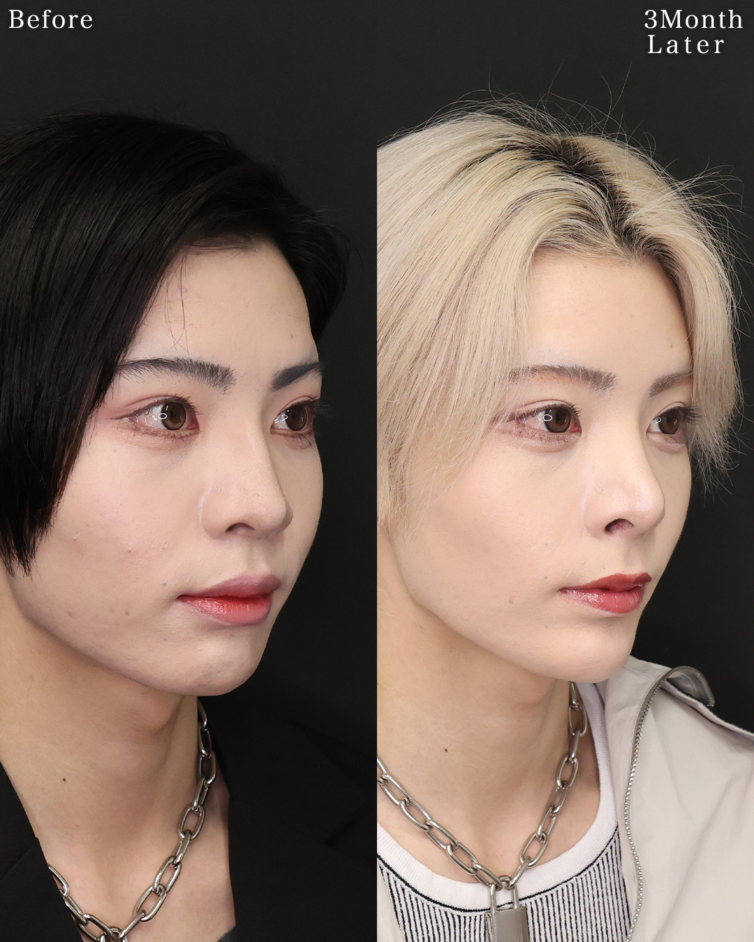 鼻中隔延長術/鼻先軟骨移植/鼻尖形成・鼻尖縮小の症例写真 施術前後 