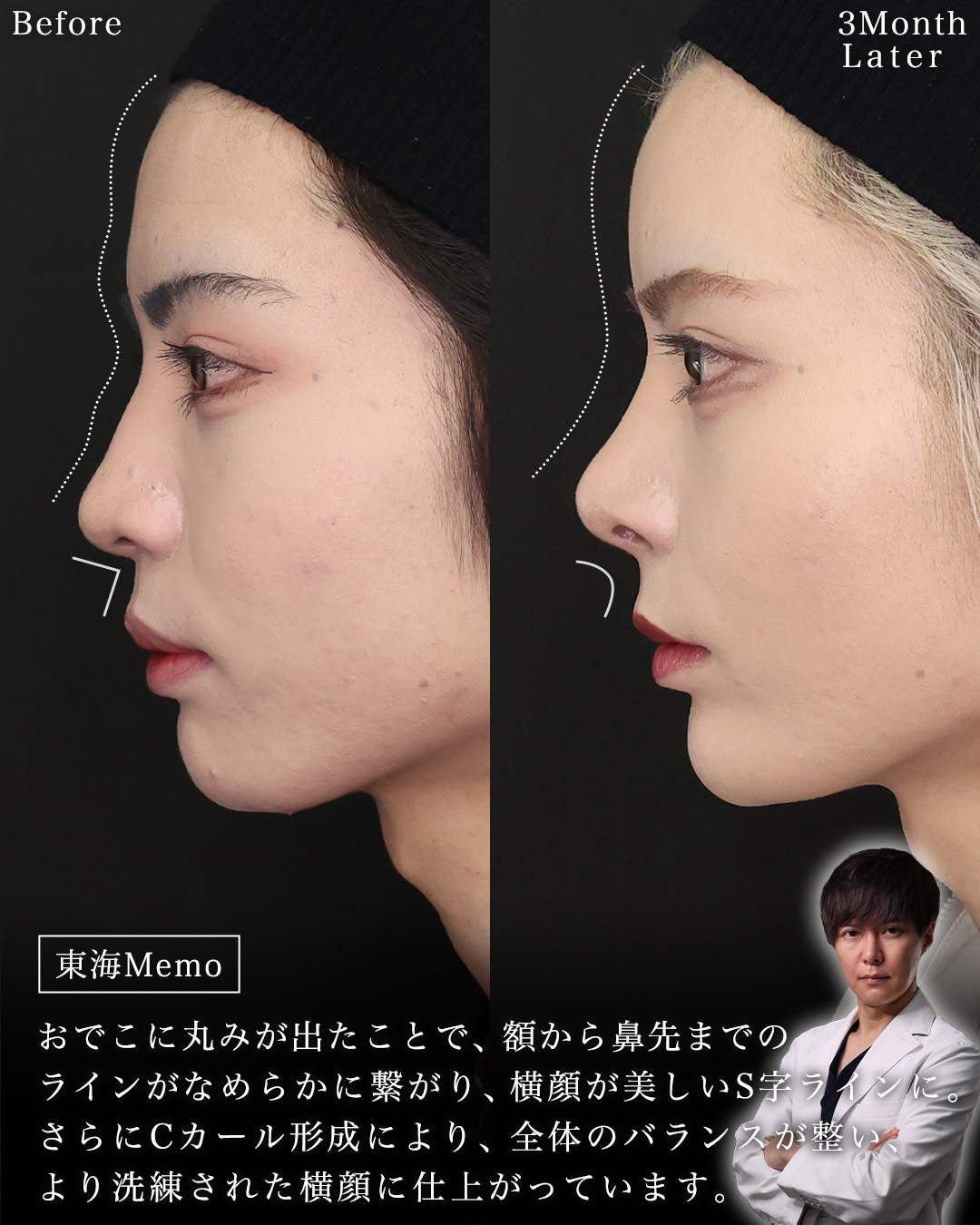 鼻中隔延長術/鼻先軟骨移植/鼻尖形成・鼻尖縮小の症例写真 施術前後 