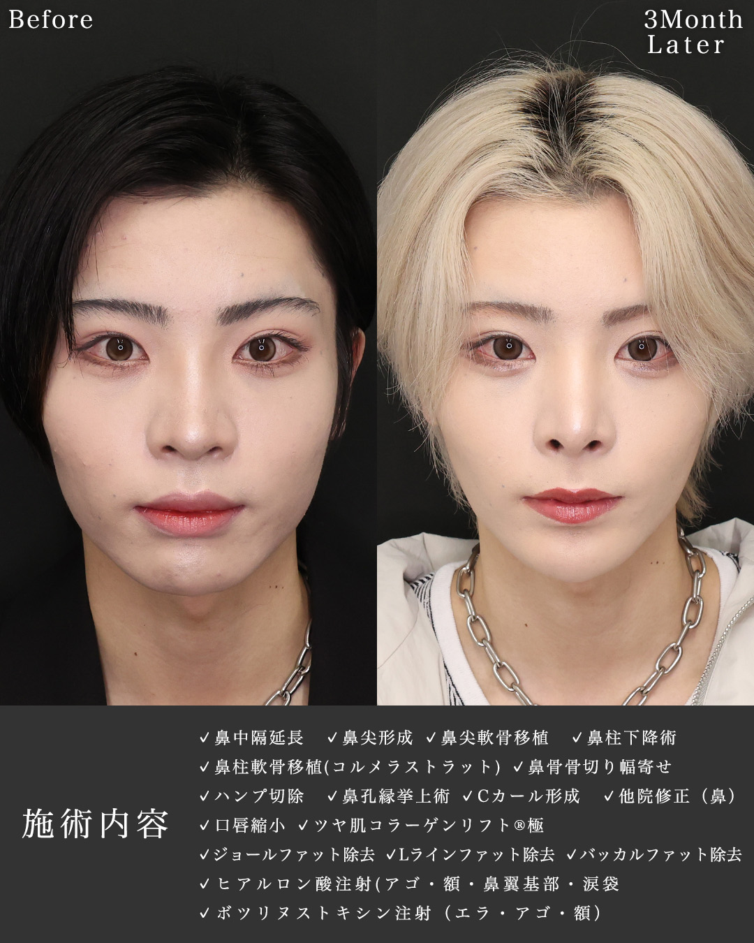 鼻中隔延長術/鼻先軟骨移植/鼻尖形成・鼻尖縮小の症例写真 施術前後 