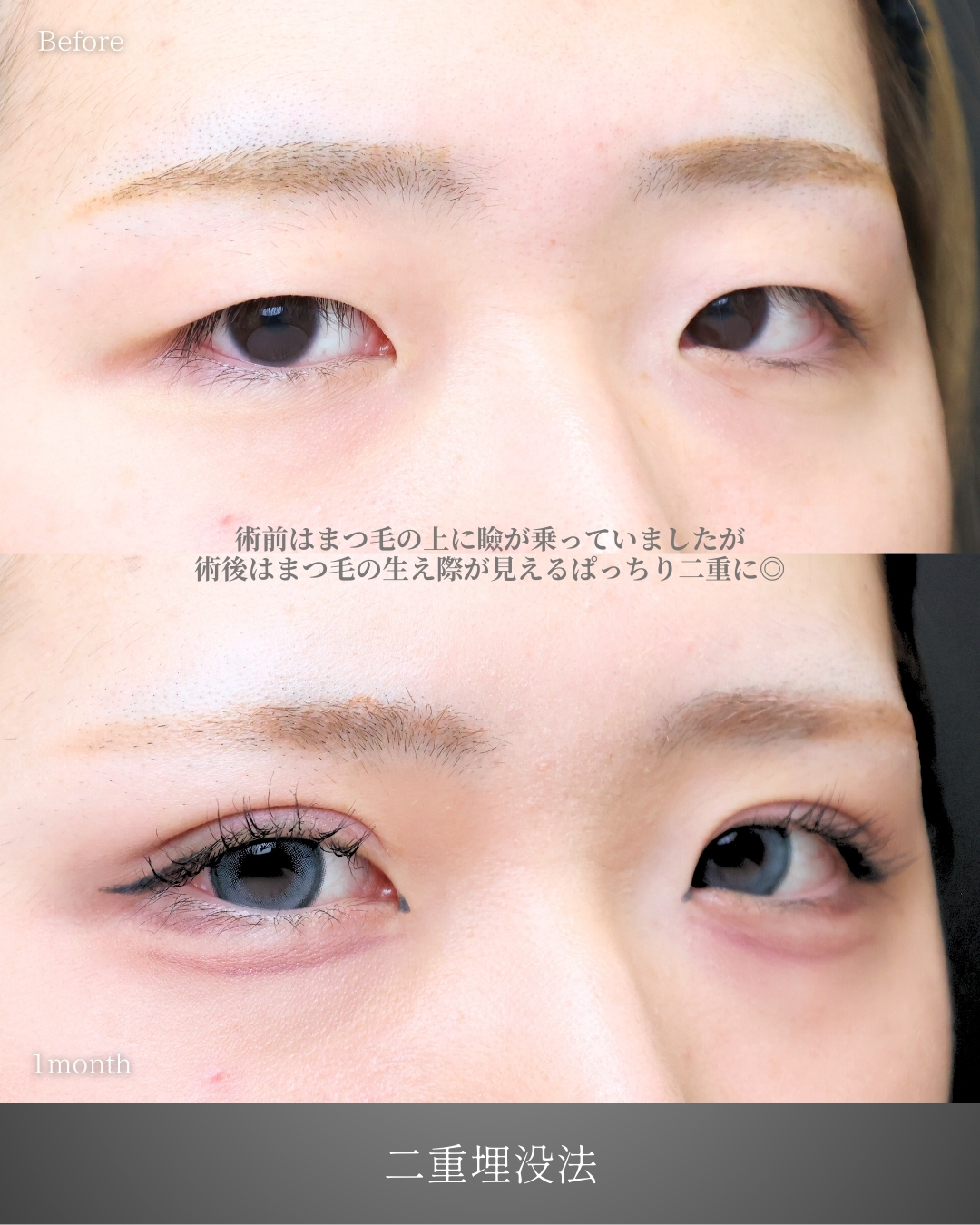 二重埋没法の症例写真 施術前後 