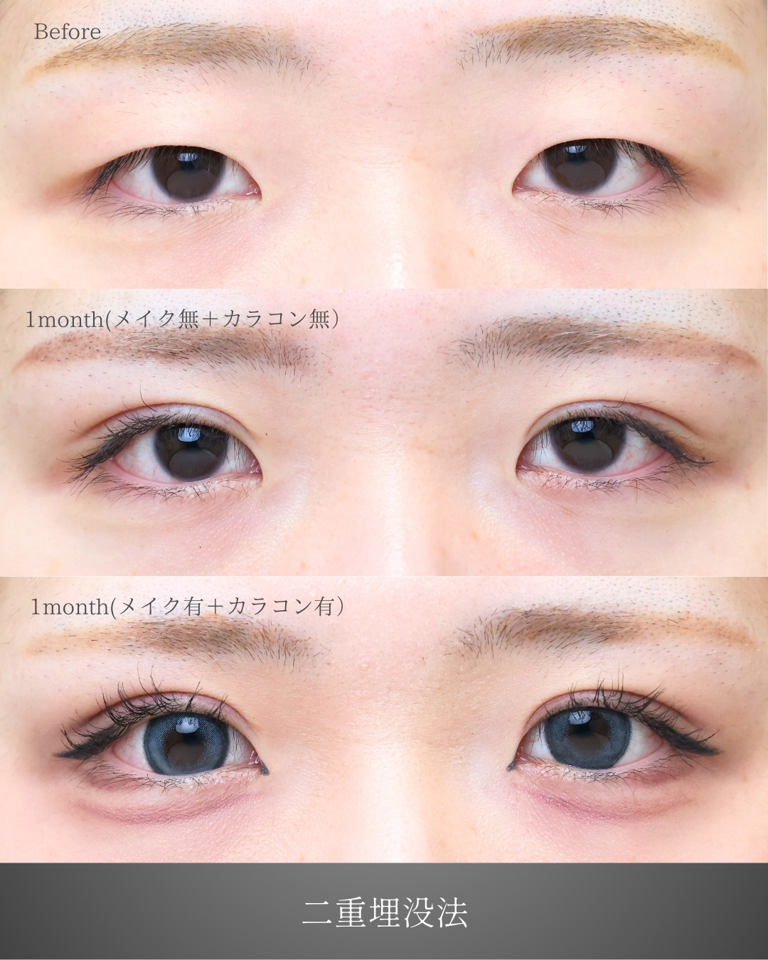 二重埋没法の症例写真 施術前後 