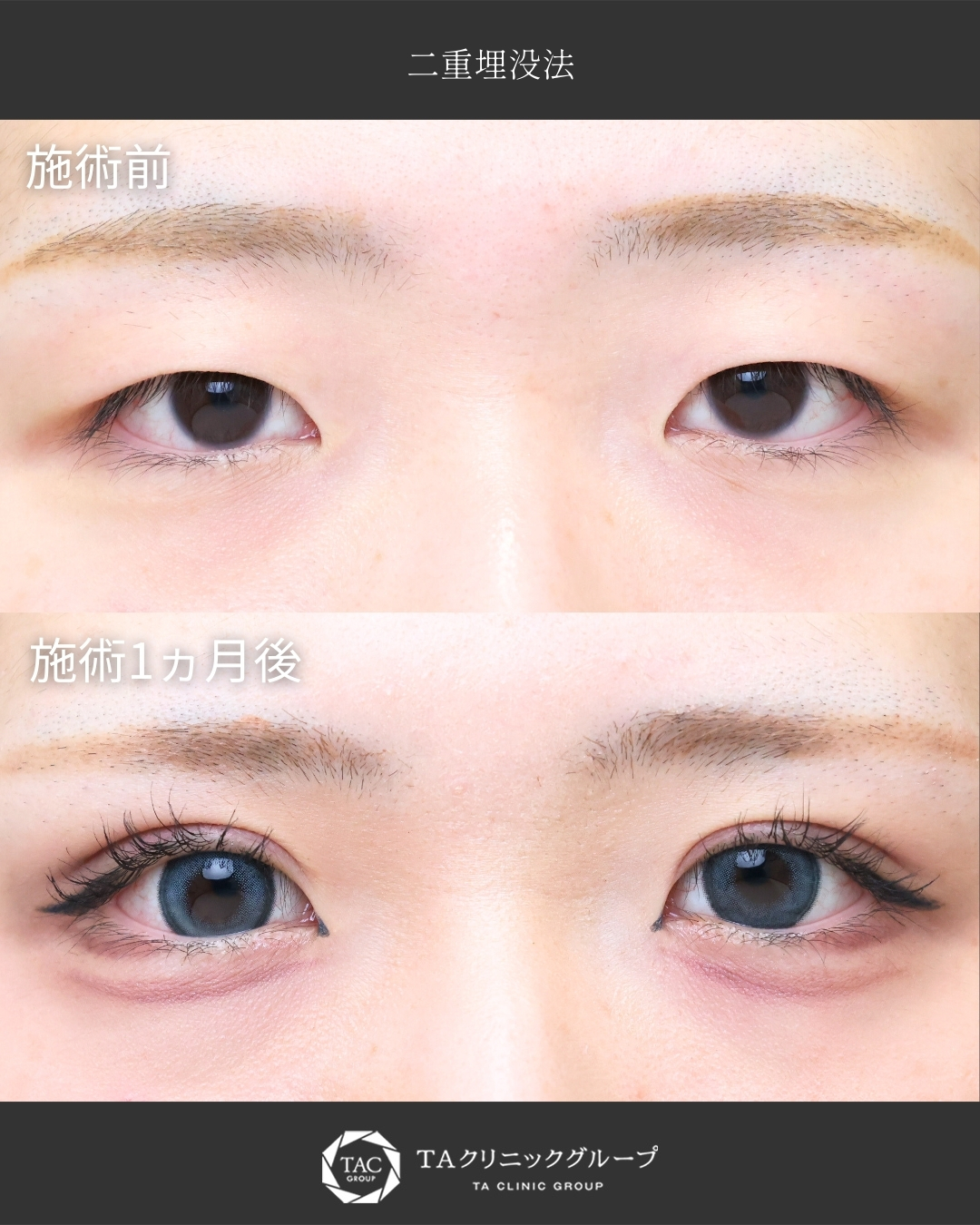 【二重埋没】まつ毛の生え際が見えるぱっちり二重に！