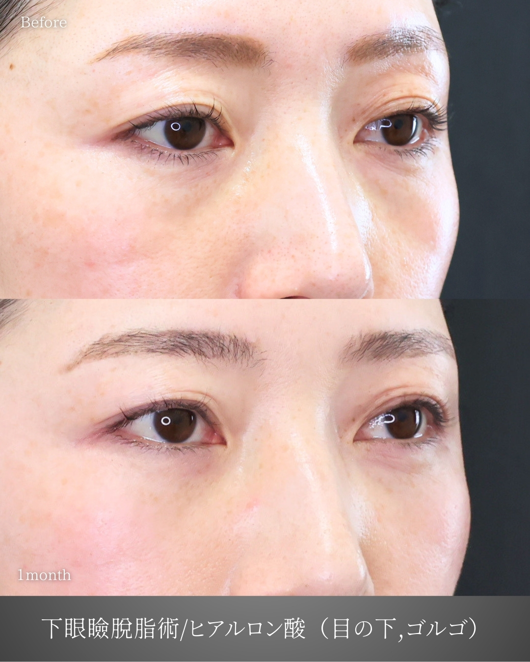 下眼瞼脱脂術（目の下のたるみ取り・目の下の脂肪ふくらみ取り）/目の下のヒアルロン酸注射/ゴルゴ線のヒアルロン酸注射の症例写真 施術前後 