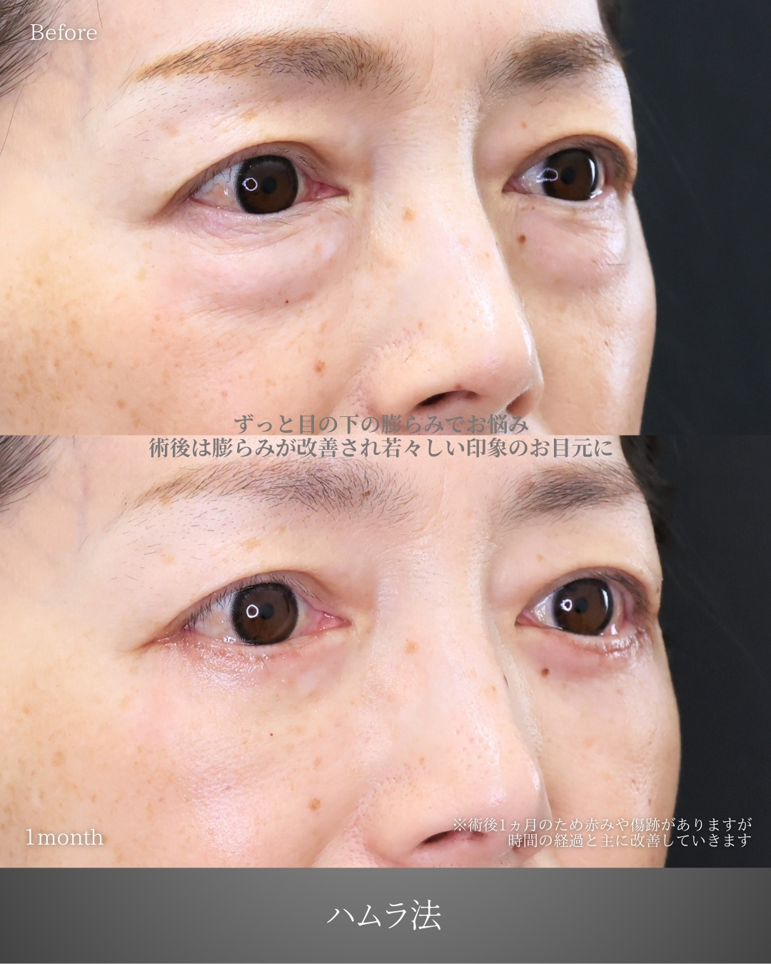 下眼瞼切開術（クマ・たるみとり）の症例写真 施術前後 