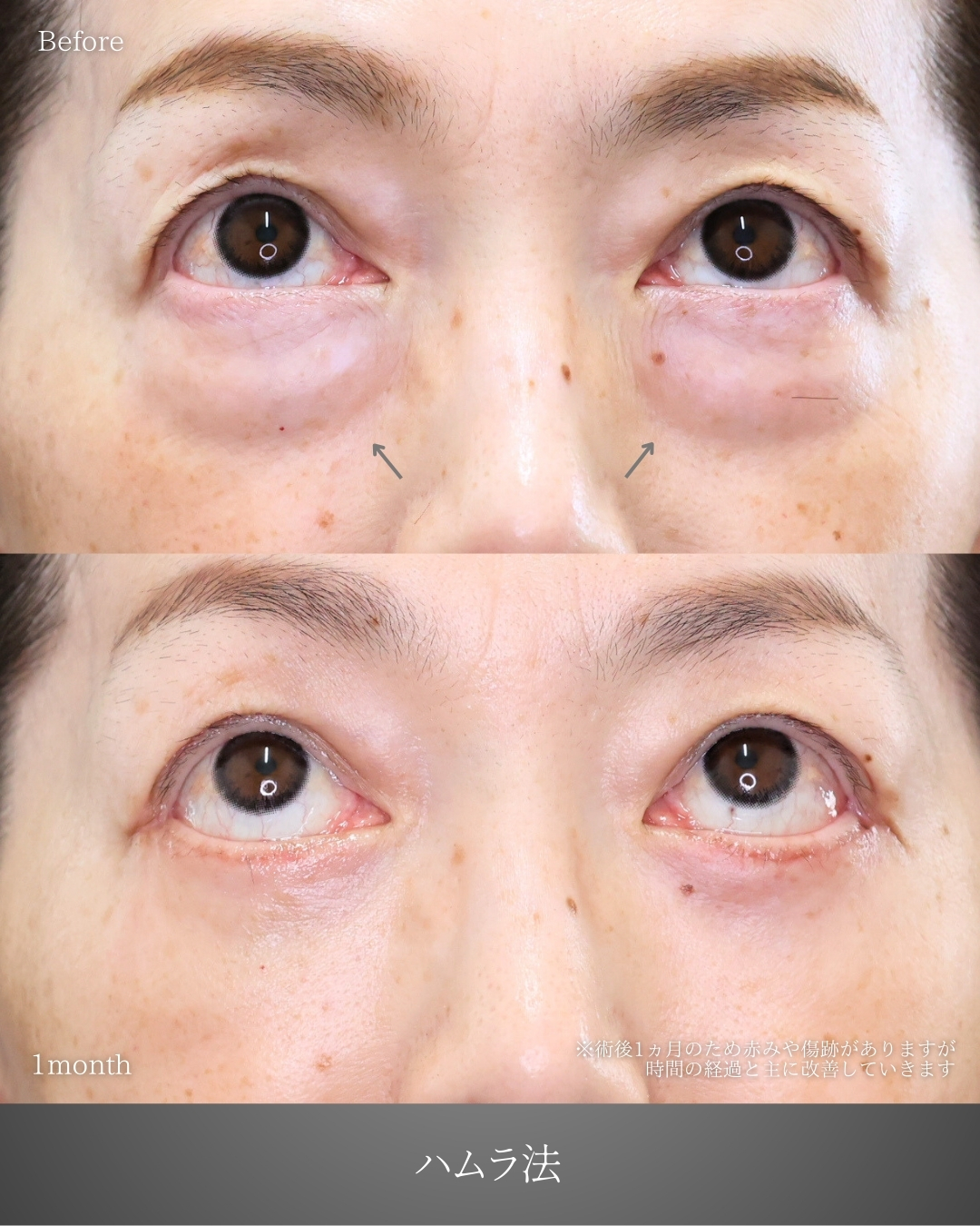 下眼瞼切開術（クマ・たるみとり）の症例写真 施術前後 