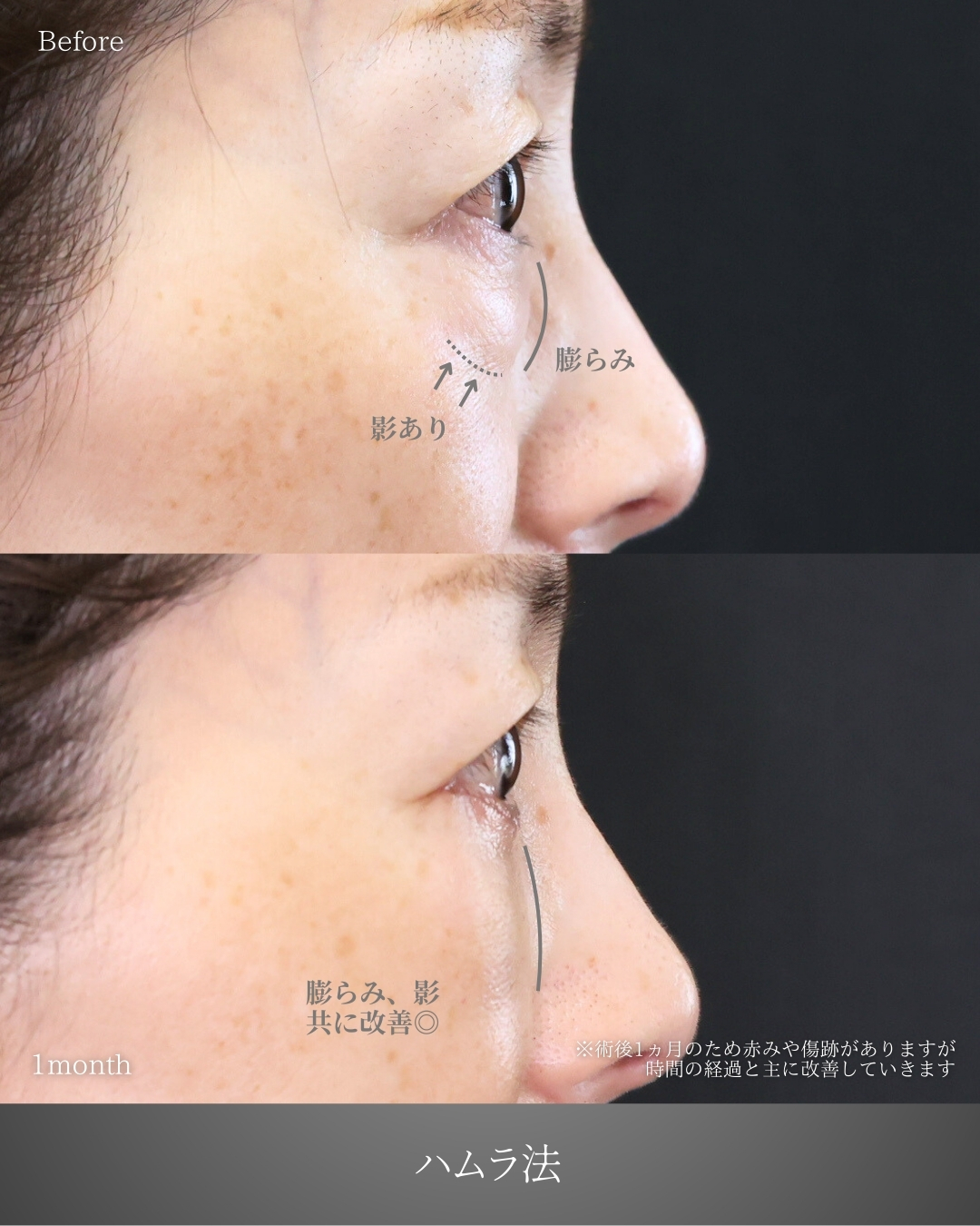 下眼瞼切開術（クマ・たるみとり）の症例写真 施術前後 