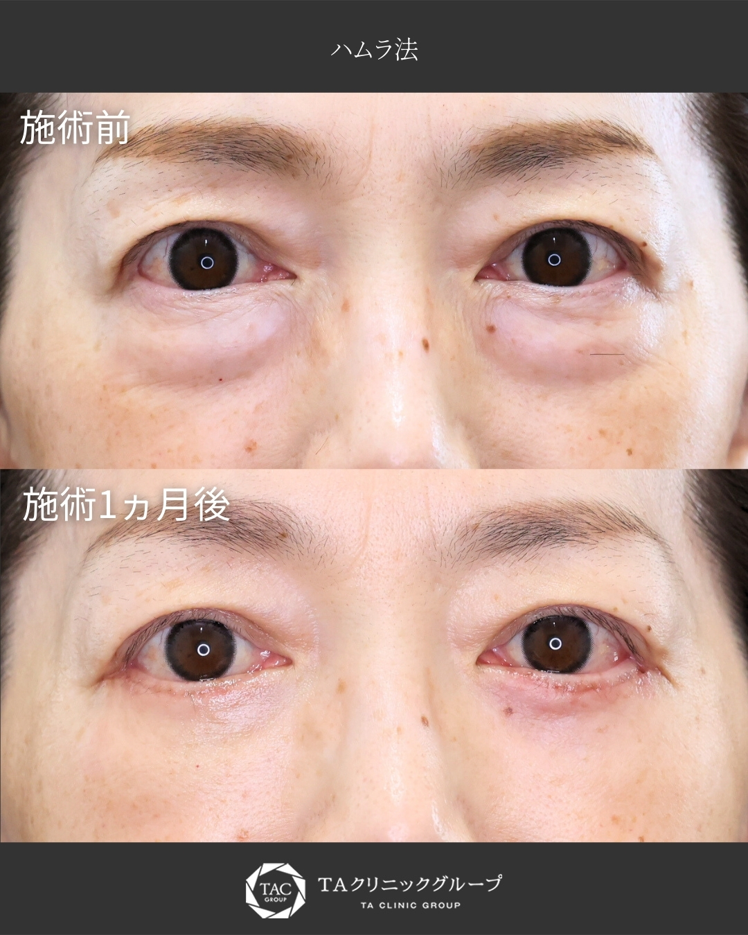 【表ハムラ法】目の下の膨らみを改善