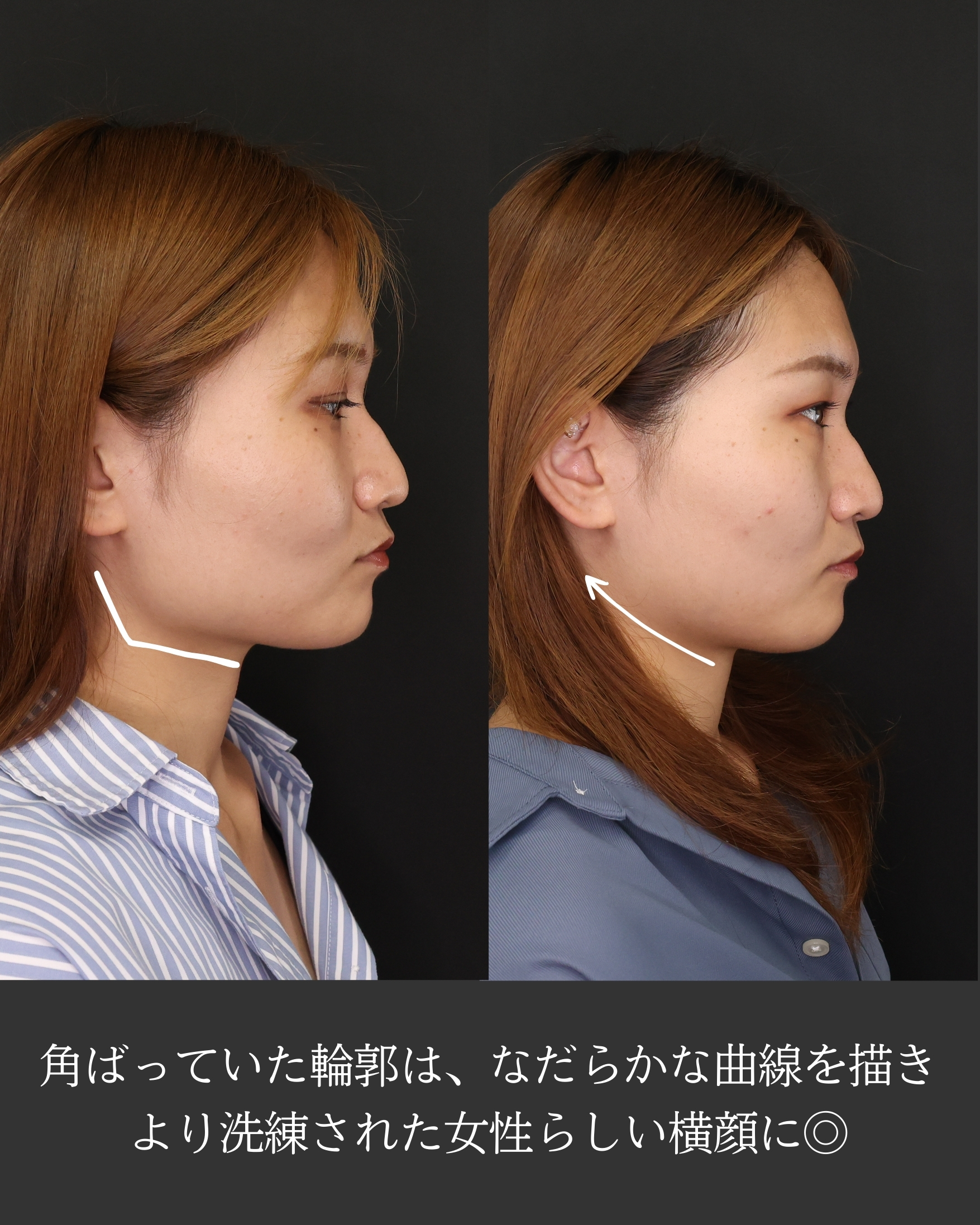 TAC式 ツヤ肌コラーゲンリフト®/ボトックス注射：その他/エラボトックス注射の症例写真 施術前後 