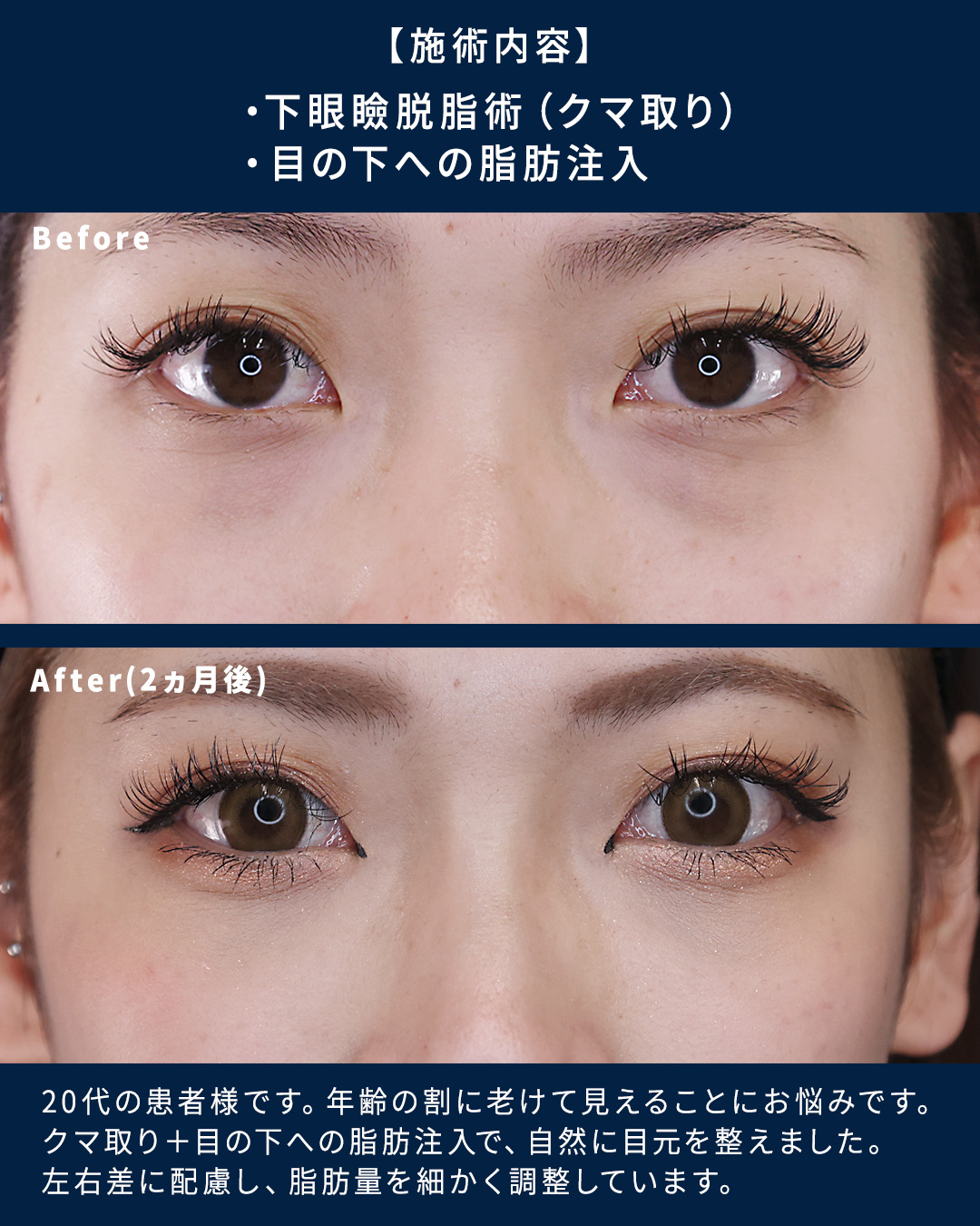 下眼瞼切開術（クマ・たるみとり）の症例写真 施術前後 