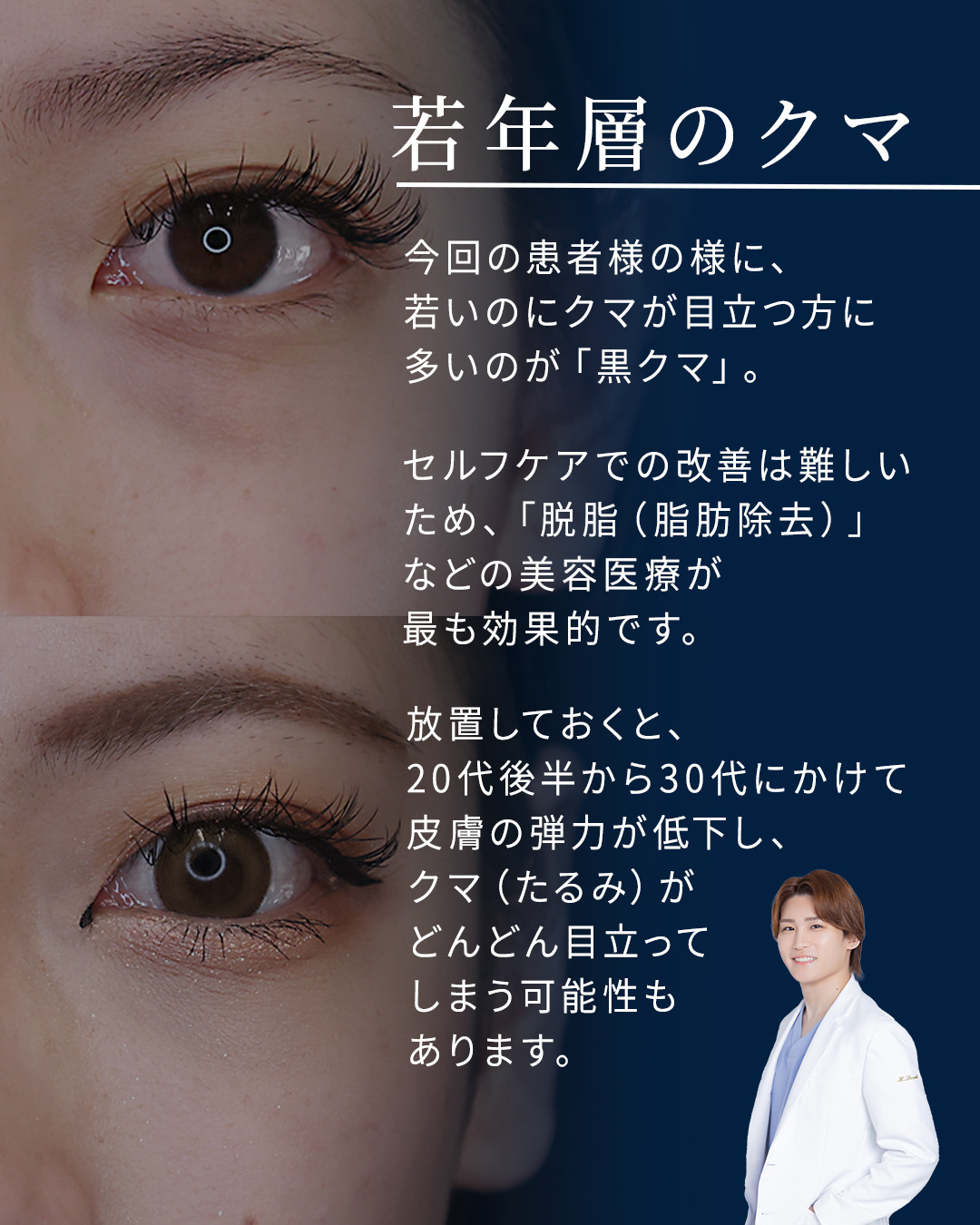 下眼瞼切開術（クマ・たるみとり）の症例写真 施術前後 