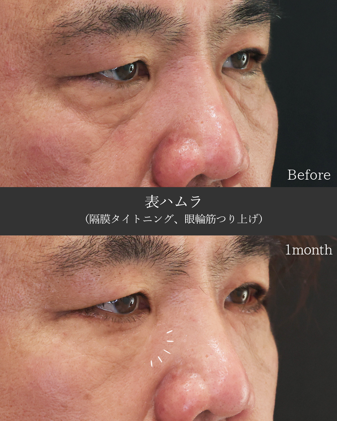 下眼瞼切開術（クマ・たるみとり）の症例写真 施術前後 