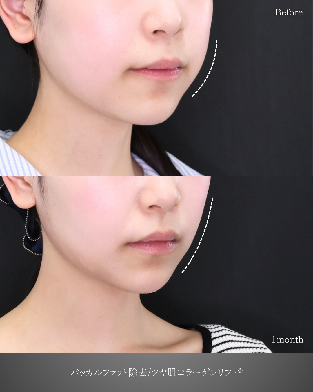 バッカルファット除去/TAC式 ツヤ肌コラーゲンリフト®の症例写真 施術前後 