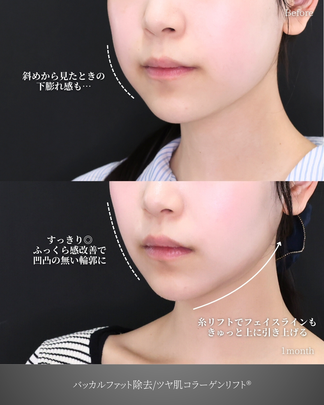 バッカルファット除去/TAC式 ツヤ肌コラーゲンリフト®の症例写真 施術前後 