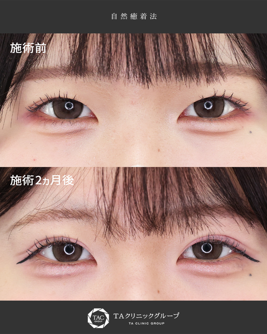 毎日のアイプチを卒業！ぱっちり可愛いお目元に│自然癒着法