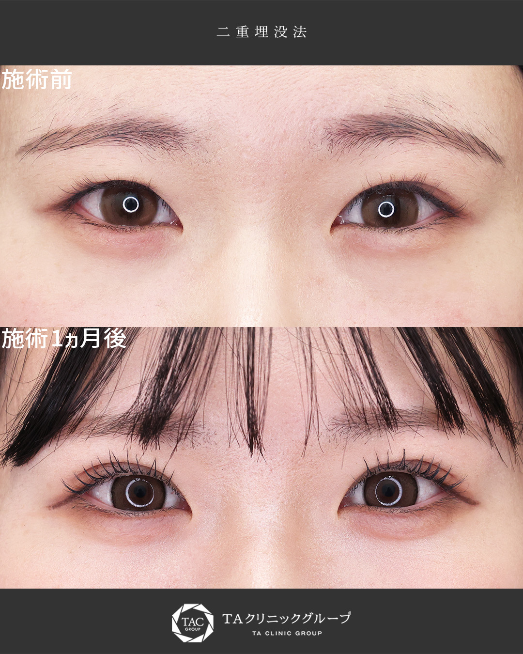 アイドル級のぱっちり可愛い二重に│二重埋没法×涙袋ヒアルロン酸