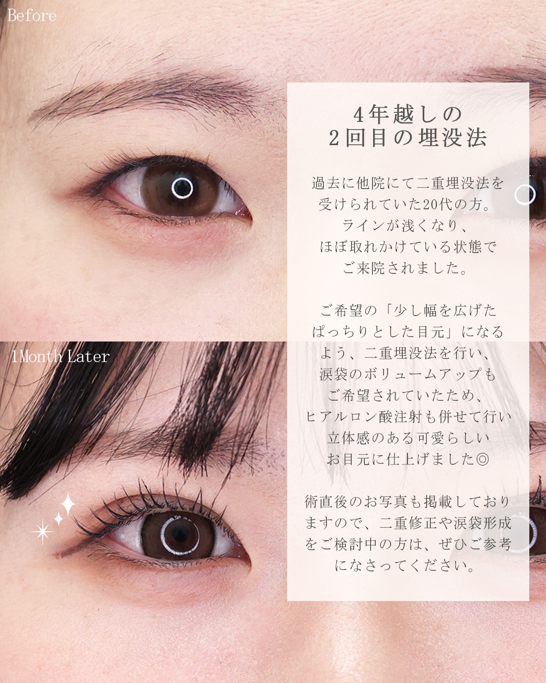 二重埋没法/涙袋形成（ヒアルロン酸注射）の症例写真 施術前後 