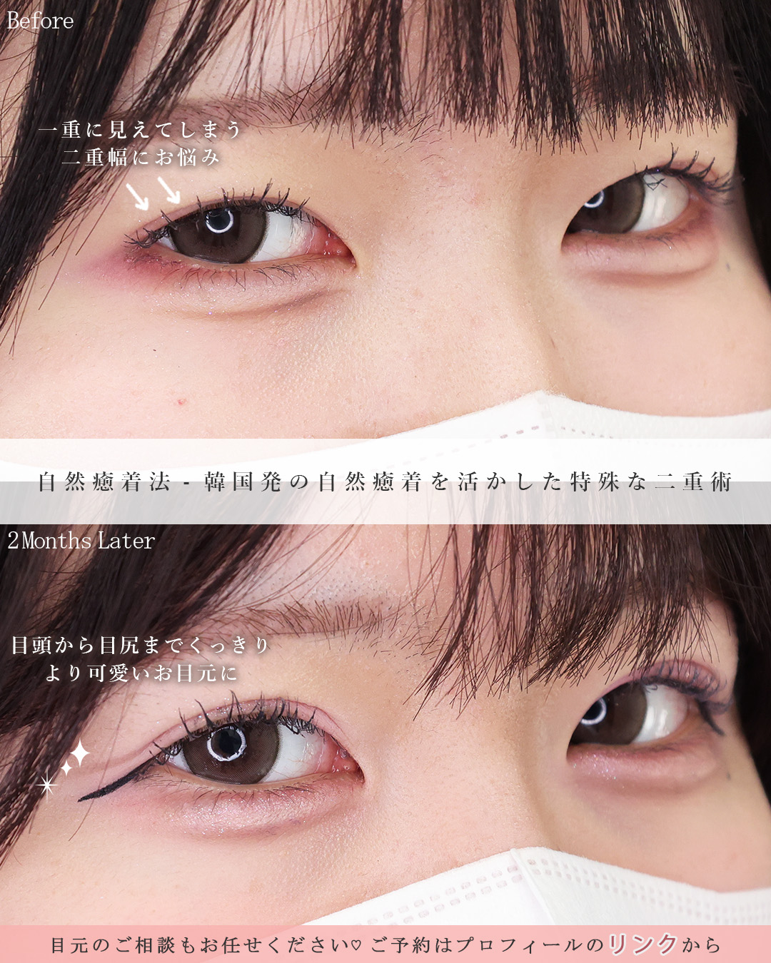 自然癒着法の症例写真 施術前後 