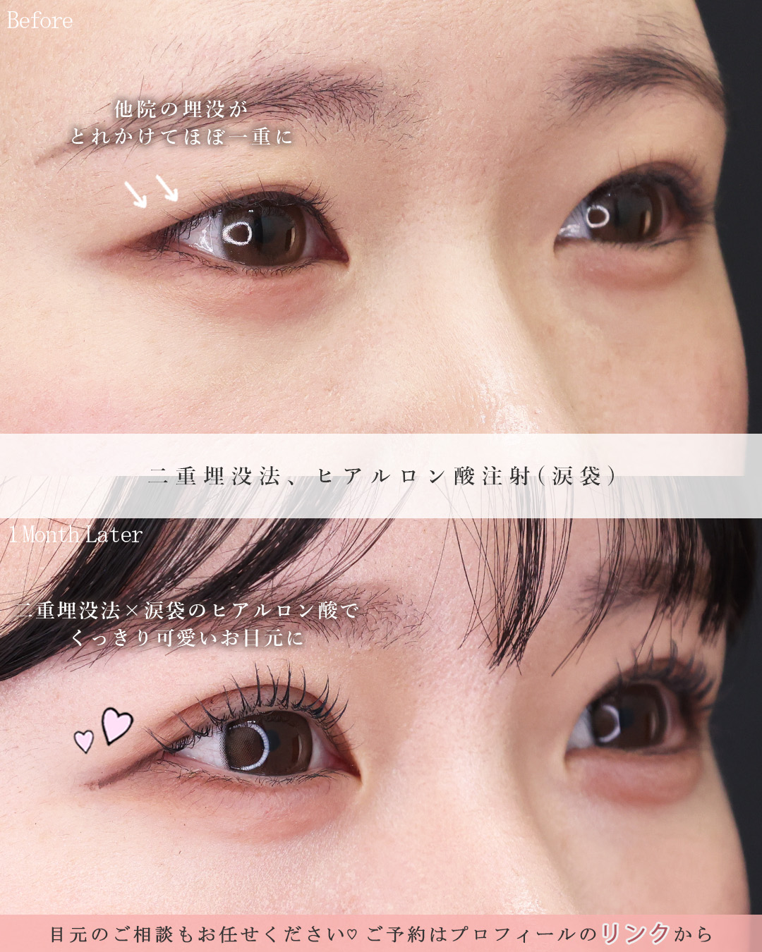 二重埋没法/涙袋形成（ヒアルロン酸注射）の症例写真 施術前後 